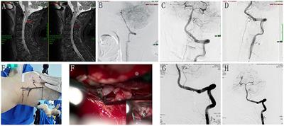 Clinical features, angio-architectural phenotypes, and treatment strategy of foramen magnum dural arteriovenous fistulas: a retrospective case series study